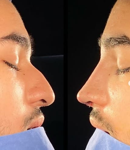 Rinoplastia caso 19 — antes y después